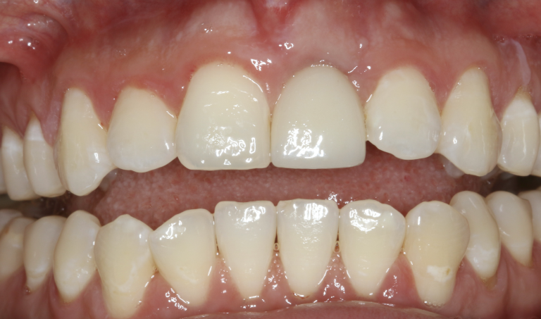 after-dental-implant-e1677000671489.png
