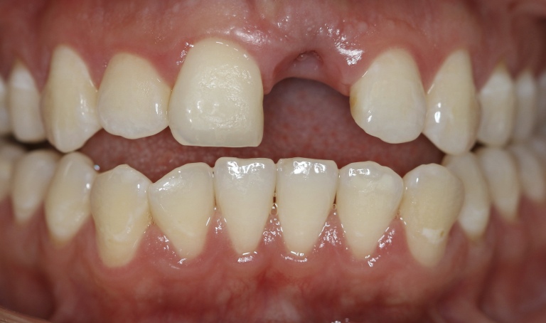 before-dental-implant-e1677000739584.png